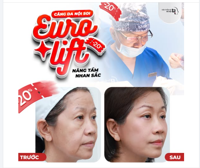 CĂNG DA NỘI SOI EURO LIFT da căng mướt - không tuổi