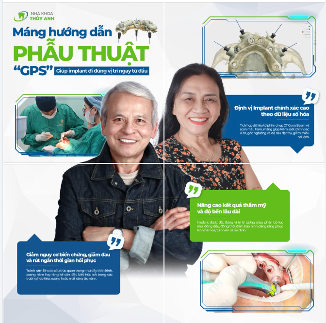 MÁNG HƯỚNG DẪN PHẪU THUẬT – “GPS” ĐỊNH VỊ TRONG CẤY GHÉP IMPLANT