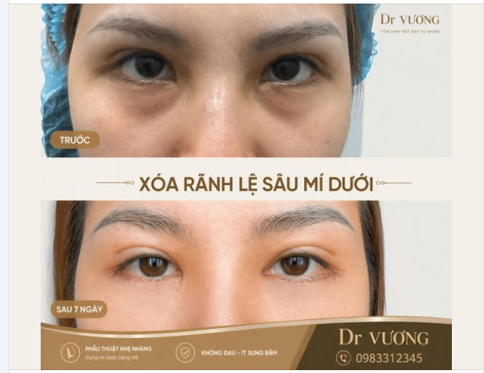 Trẻ rõ sau 7 ngày với can thiệp tối thiểu = combo xoá rãnh lệ sâu mí dưới với Dr Vương