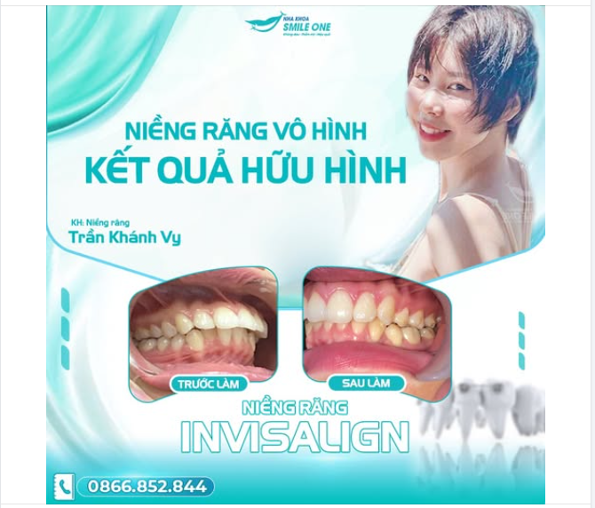 NIỀNG RĂNG VÔ HÌNH - KẾT QUẢ HỮU HÌNH