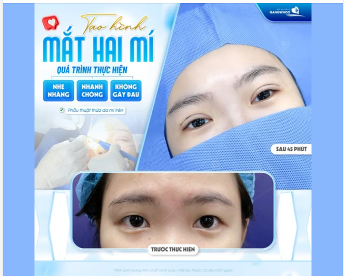 TẠO HÌNH MẮT HAI MÍ – ĐẸP TỰ NHIÊN