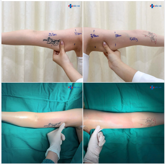 HÚT MỠ CÁNH TAY HIỆU QUẢ NHƯ THẾ NÀO?