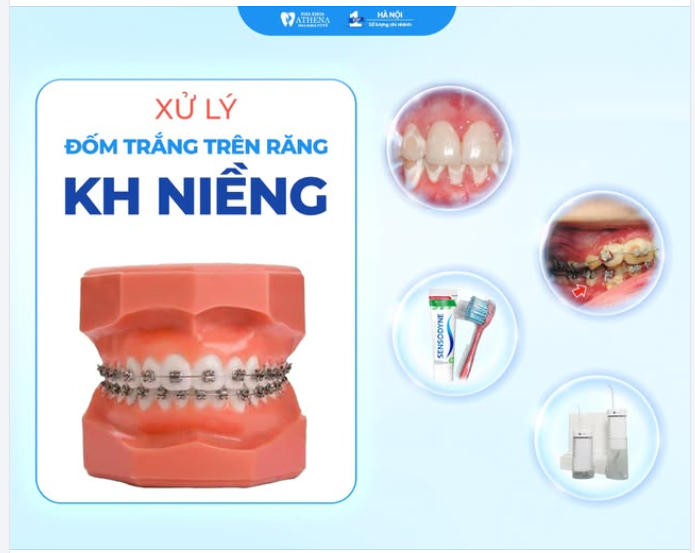Làm sao xử lý đốm trắng trên răng khi niềng?