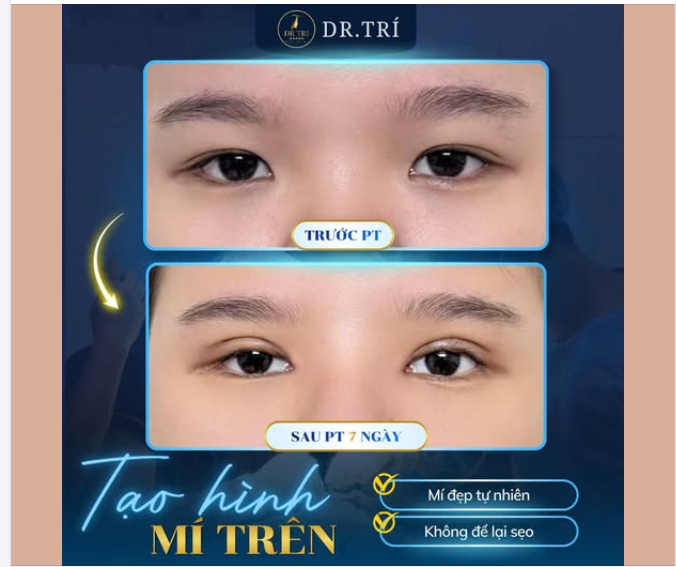 MÍ ĐẸP TỰ NHIÊN – KHÔNG SẸO, KHÔNG ĐƠ CỨNG