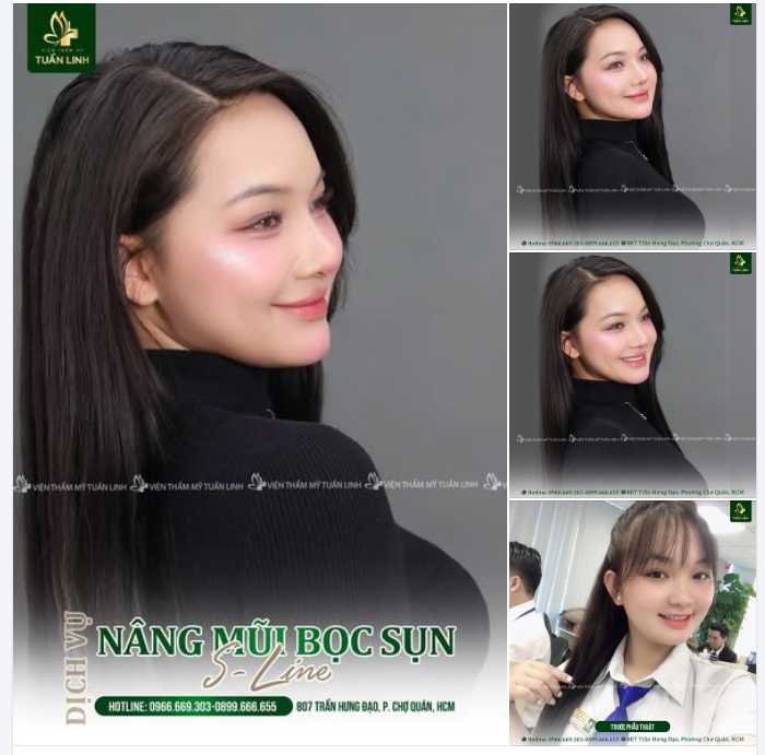 Thăng hạng nhan sắc với dáng mũi mới