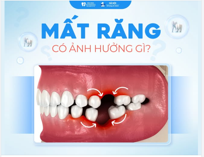 MẤT RĂNG ẢNH HƯỞNG NHƯ NÀO?