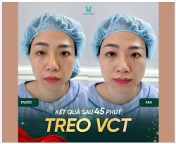 TẠM BIỆT MẮT SỤP MÍ MỆT MỎI