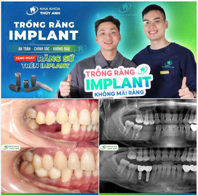 CẢM NHẬN ĂN NHAI KHÁC HẲN SAU KHI HOÀN THIỆN TRỒNG 2 RĂNG IMPLANT