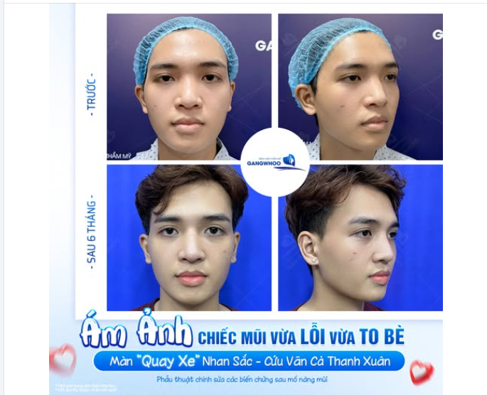 ÁM ẢNH MŨI "LỖI" - TO BÈ