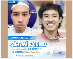 ÁNH NHÌN KÉM SẮC? MẮT LỜ ĐỜ?