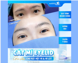 CẮT MÍ EYELID - GIẢI PHÁP CHO MẮT MỘT MÍ VÀ MÍ LÓT