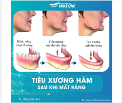 BAO LÂU SAU KHI MẤT RĂNG THÌ BẮT ĐẦU TIÊU XƯƠNG HÀM