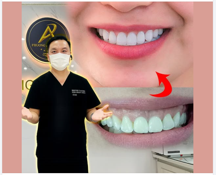 Làm cầu răng sứ có gây hôi miệng không ?