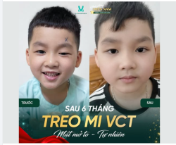 KẾT QUẢ SAU 6 THÁNG TREO VẠT CƠ TRÁN