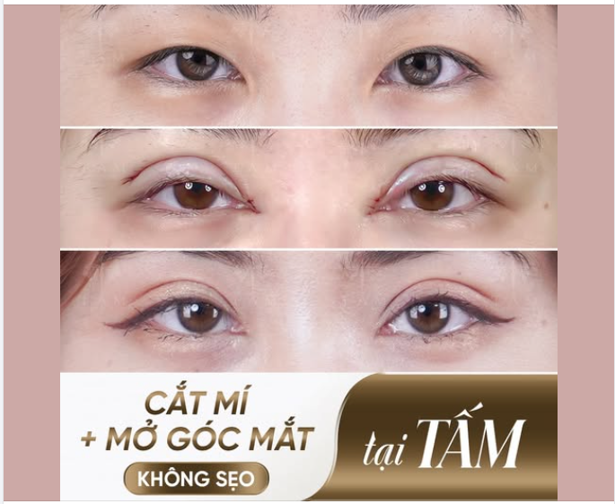 "TẠM BIỆT"  MẮT 1 MÍ  MÍ LÓT  DA TRÙNG, THỪA NHIỀU