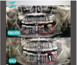 Trong khi mọi người đang nghỉ ngơi, bác Dương và ekip vẫn miệt mài thông trưa để giúp một khách hàng nữ Gen Z lấy lại hàm răng chắc khỏe.