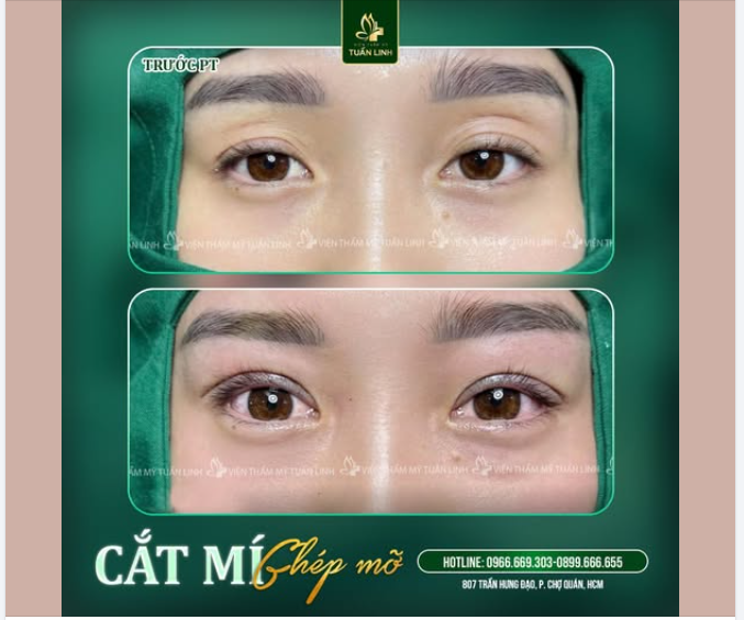 CẮT MÍ GHÉP MỠ – GIẢI PHÁP 2IN1 CHO ĐÔI MẮT TRẺ TRUNG, TỰ NHIÊN!!