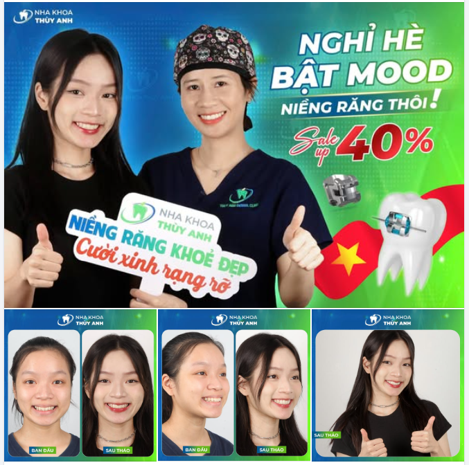 BẬT MOOD NIỀNG RĂNG – SẴN SÀNG TỰ TIN HƠN MÙA HÈ NÀY