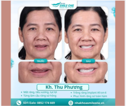 HỒI SINH NỤ CƯỜI – TỰ TIN TẬN HƯỞNG CUỘC SỐNG NHỜ CÔNG NGHỆ IMPLANT