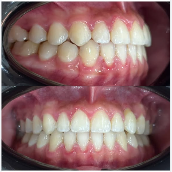 Thời Gian Hoàn Thành Quá Trình Niềng Răng Là Bao Lâu