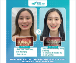 Bạn Anh Đào khi bắt đầu đến nha khoa Smile One với tình trạng:
