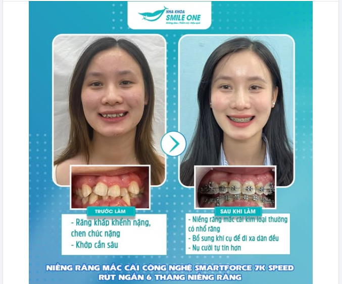 Bạn Anh Đào khi bắt đầu đến nha khoa Smile One với tình trạng: