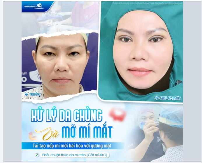 XỬ LÝ DA CHÙNG MỠ MÍ MẮT