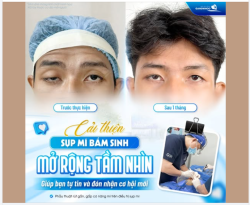 CẢI THIỆN SỤP MÍ BẨM SINH – MỞ RỘNG TẦM NHÌN, TỰ TIN HƠN MỖI NGÀY
