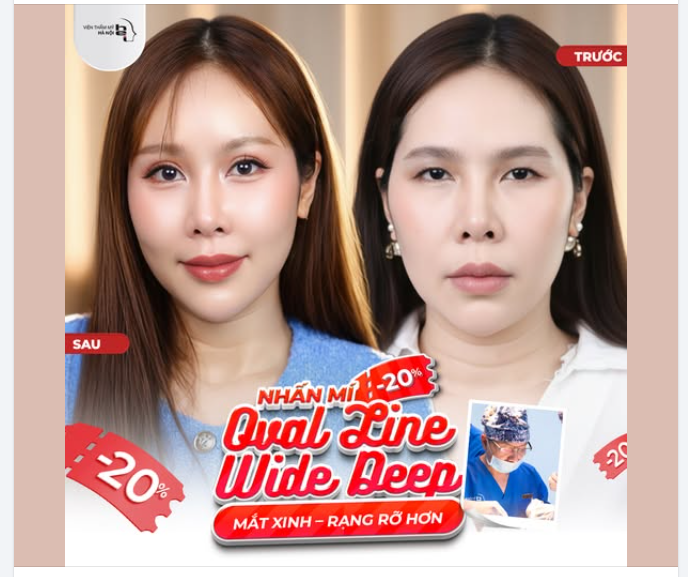 NHẤN MÍ OVAL LINE WIDE DEEP - MẮT ĐẸP HÚT HỒN