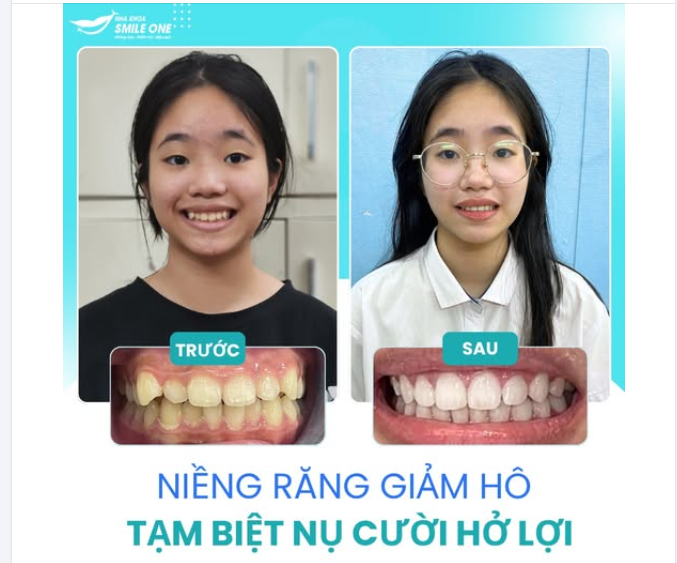 GIẢM HÔ – TẠM BIỆT NỤ CƯỜI HỞ LỢI.