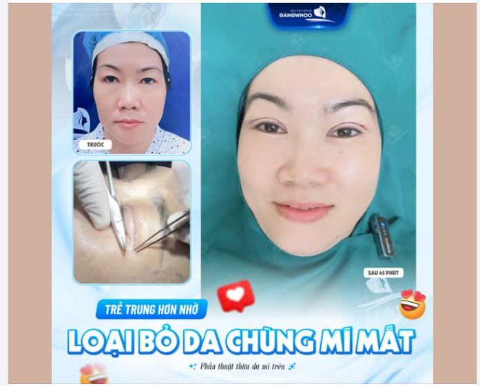 CUỐI TUẦN ĐI LÀM ĐẸP – TRẺ TRUNG HƠN NHỜ LOẠI BỎ DA CHÙNG MÍ MẮT