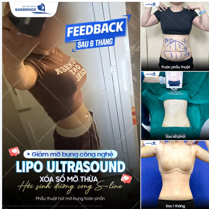 FEEDBACK GIẢM MỠ BỤNG LIPO ULTRASOUND