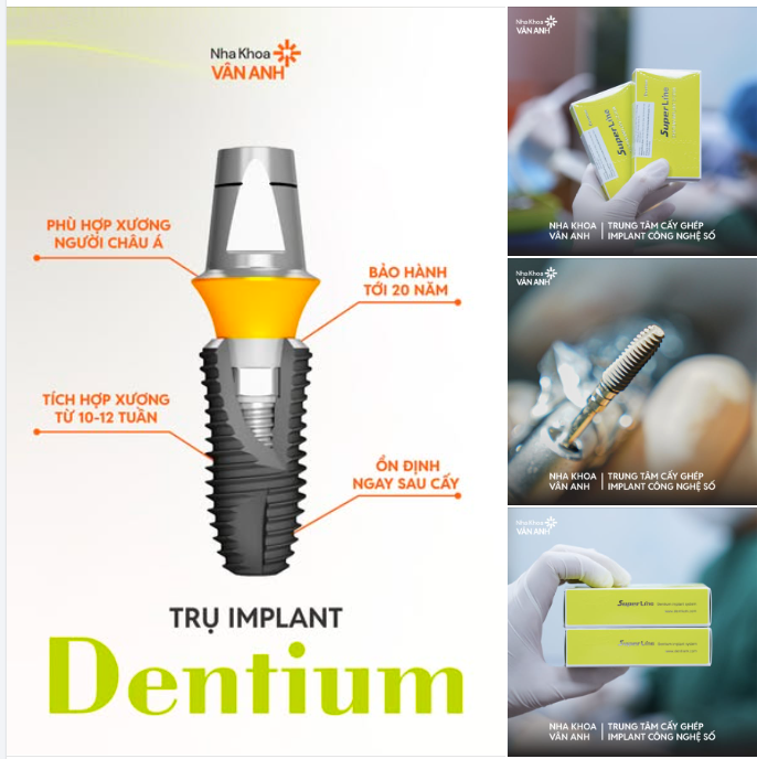 Hàng chục loại trụ implant trên thị trường, nên chọn loại nào đây bác sĩ?