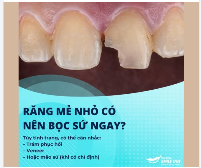 RĂNG MẺ NHỎ CÓ NÊN BỌC SỨ NGAY?