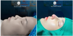 Có Lòng Nâng Mũi Có Ngày Được Mũi Xinh