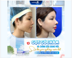 GỌT GÓC HÀM VÀ CHỈNH SỬA DÁNG MŨI