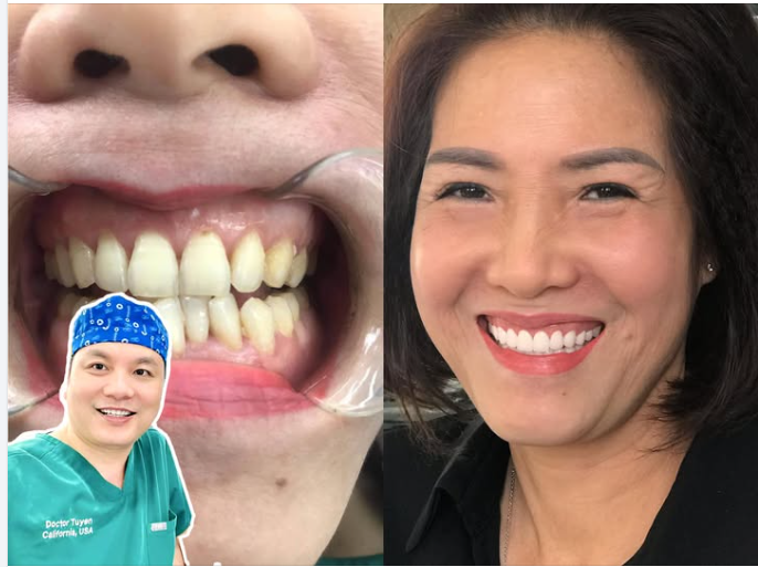 Không trồng răng giả sau khi nhổ răng có sao không?