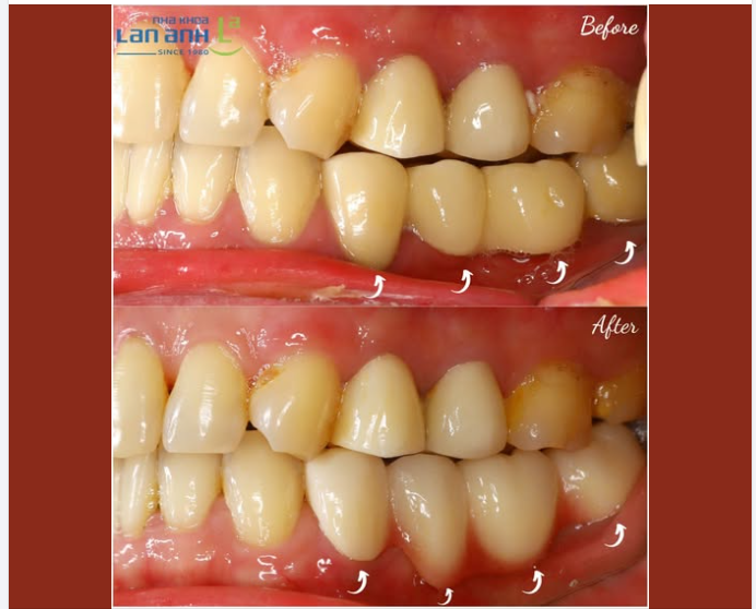Nhược điểm của cầu răng sứ