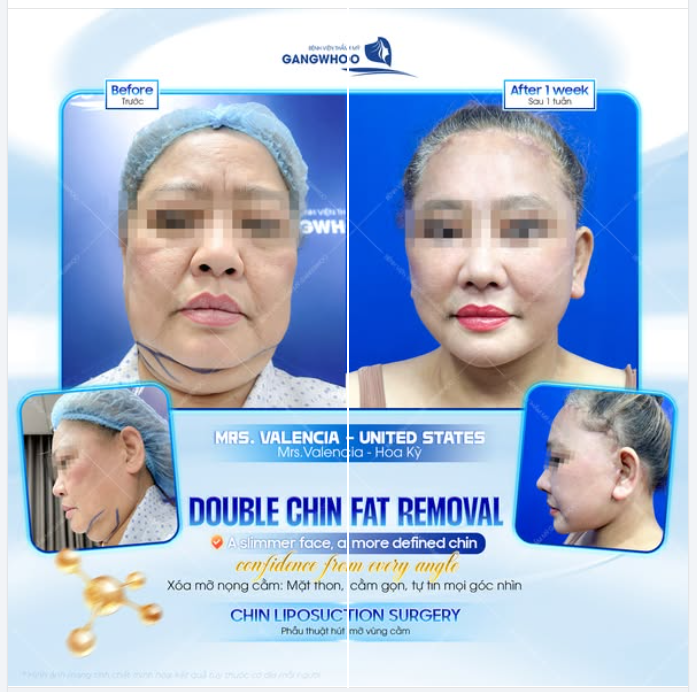 Trở về từ Hoa Kỳ, Mrs. Valencia mong muốn cải thiện vùng cằm để gương mặt trông hài hòa hơn khi chụp ảnh và trong sinh hoạt hằng ngày.