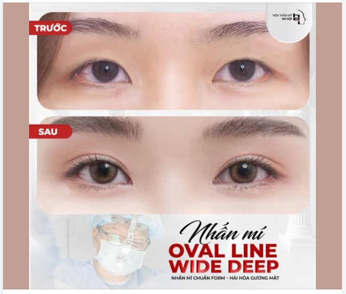 NHẤN MÍ OVAL LINE WIDE DEEP – MẮT SANG CHẢNH, QUYẾN RŨ