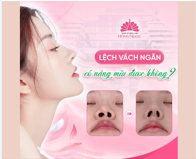 LỆCH VÁCH NGĂN MŨI CÓ NÂNG MŨI ĐƯỢC KHÔNG?