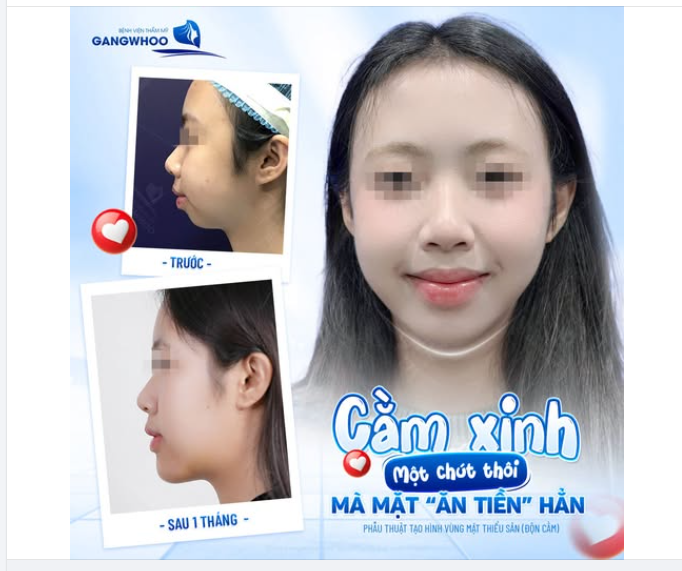 Chỉ sau 1 tháng nâng cấp giao diện bằng phương pháp độn cằm, chị khách nhà Gangwhoo đã chính thức "phá bỏ phong ấn" nhan sắc. Nhìn cái góc nghiêng trước - sau là thấy chấn động liền!