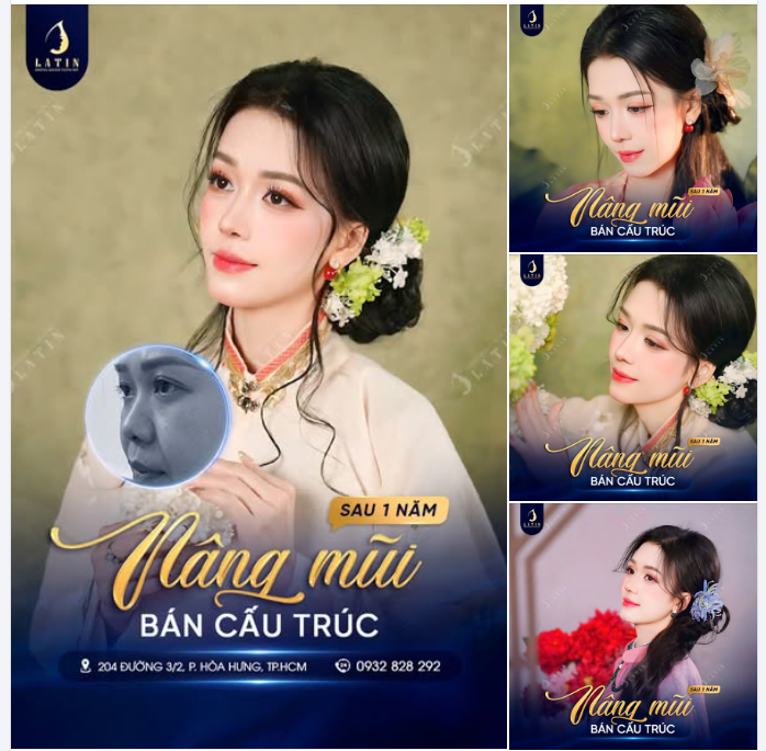 Feedback dáng mũi bán cấu trúc sau 1 năm