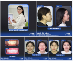 Tháo niềng sau 2.5 năm — Nụ cười thay đổi nhẹ nhàng nhưng rõ rệt