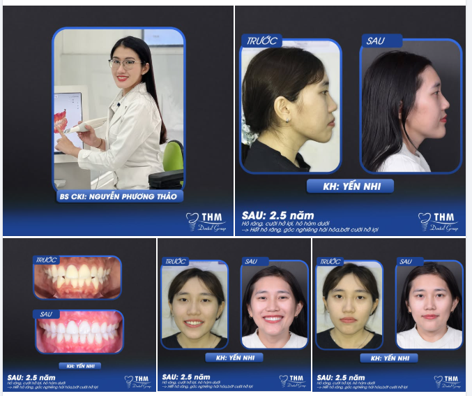 Tháo niềng sau 2.5 năm — Nụ cười thay đổi nhẹ nhàng nhưng rõ rệt
