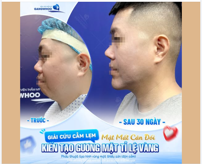 GIẢI CỨU CẰM LẸM - MẶT MẤT CÂN ĐỐI