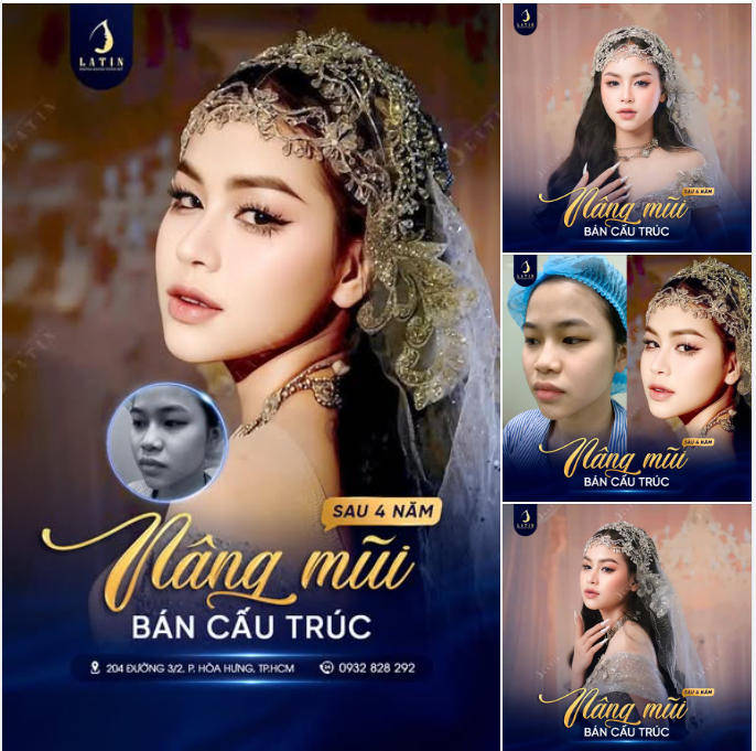MŨI XINH BỀN VỮNG – RẠNG NGỜI TỰ TIN