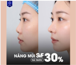 Tái cấu trúc dáng mũi - Nâng cấp thần thái