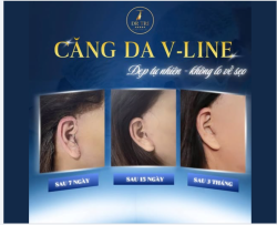 TRẺ LẠI 10 TUỔI CÙNG CÔNG NGHỆ CĂNG DA V-LINE TẠI DR. TRÍ