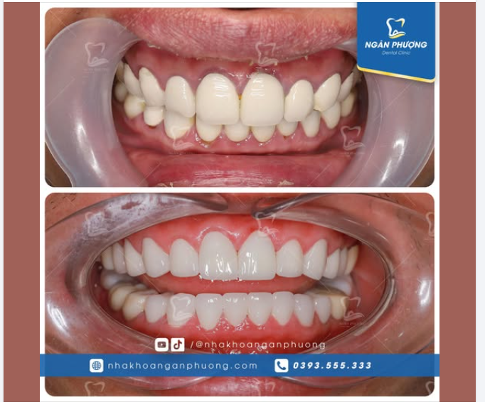 Từ tình cờ thành mối lương duyên, cảm ơn anh Xuân Phúc đã tin tưởng Nha khoa Ngân Phượng